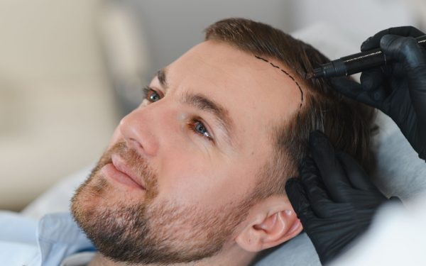 Cercetările recente aduc înaintea ochilor noștri un pas major în domeniul medicinei regeneratoare: pentru prima oară, oamenii de știință au reușit să cultive în laborator foliculi de păr complet funcționali