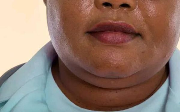 Bărbia dublă nu mai este doar o problemă estetică, ci și un semnal de alarmă pentru probleme de sănătate mai complexe