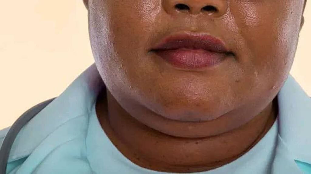 Bărbia dublă nu mai este doar o problemă estetică, ci și un semnal de alarmă pentru probleme de sănătate mai complexe