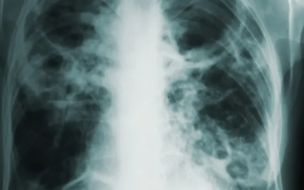 Ziua Mondială de Luptă Împotriva Tuberculozei, marcată simbolic la București Arcul de Triumf din București se va ilumina în culoarea roșu în seara de 24 martie, la inițiativa autorităților, pentru a marca Ziua Mondială de Luptă împotriva Tuberculozei