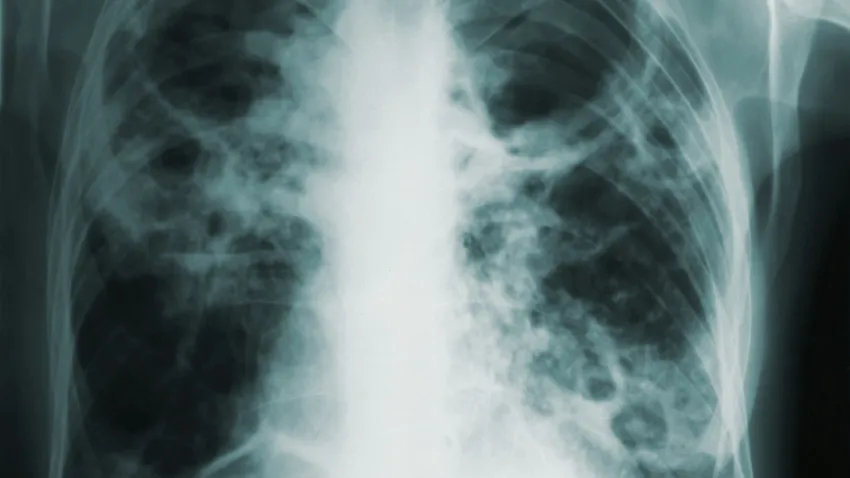 Ziua Mondială de Luptă Împotriva Tuberculozei, marcată simbolic la București Arcul de Triumf din București se va ilumina în culoarea roșu în seara de 24 martie, la inițiativa autorităților, pentru a marca Ziua Mondială de Luptă împotriva Tuberculozei