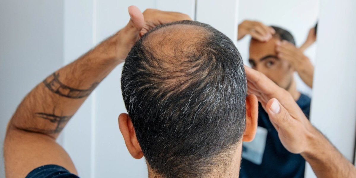 O descoperire promițătoare în lupta împotriva cheliei a fost făcută recent de cercetători, care au reușit să crească în laborator foliculi de păr funcționali