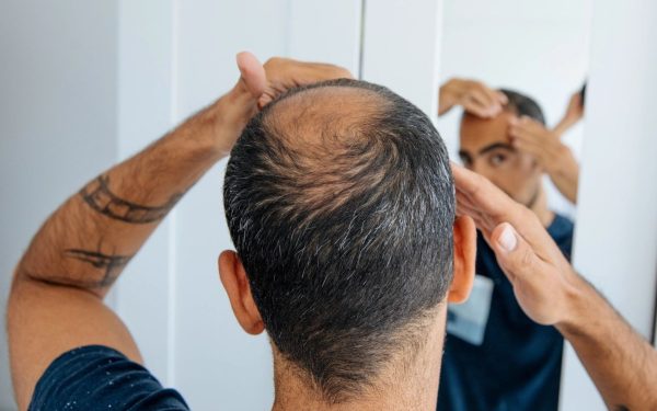 O descoperire promițătoare în lupta împotriva cheliei a fost făcută recent de cercetători, care au reușit să crească în laborator foliculi de păr funcționali