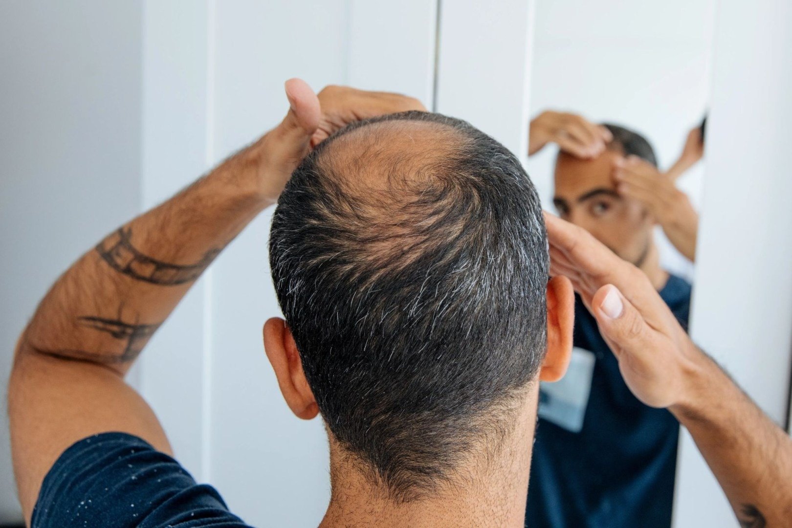 O descoperire promițătoare în lupta împotriva cheliei a fost făcută recent de cercetători, care au reușit să crească în laborator foliculi de păr funcționali