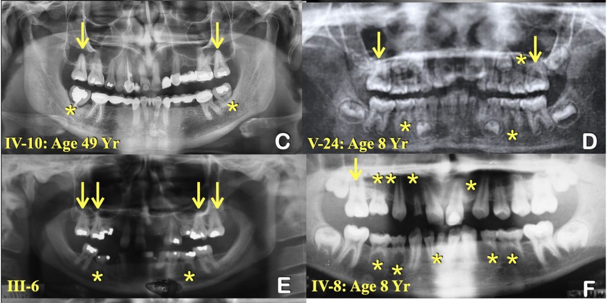 Un cercetător din Statele Unite a elucidat misterul genetic din spatele unei afecțiuni rare care a bântuit familia lui timp de decades — lipsa completă a dinților, o condiție cunoscută ca agenezie dentară