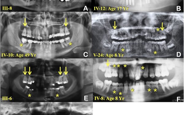 Un cercetător din Statele Unite a elucidat misterul genetic din spatele unei afecțiuni rare care a bântuit familia lui timp de decades — lipsa completă a dinților, o condiție cunoscută ca agenezie dentară