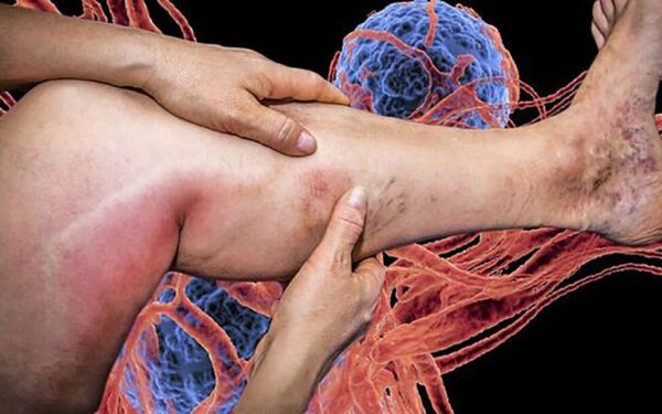 Descifrarea formării cheagurilor de sânge după vaccinarea anti-COVID: o enigmă în proces de soluționare De mai bine de doi ani, campania globală de vaccinare împotriva COVID-19 a fost un pilon esențial în încercarea de a limita răspândirea virusului și de a salva vieți