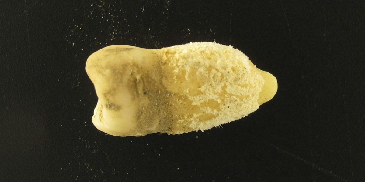 Scarlatina precolumbiană: Cum schimbă o mumie istoria medicinei