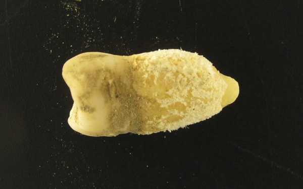 Scarlatina precolumbiană: Cum schimbă o mumie istoria medicinei