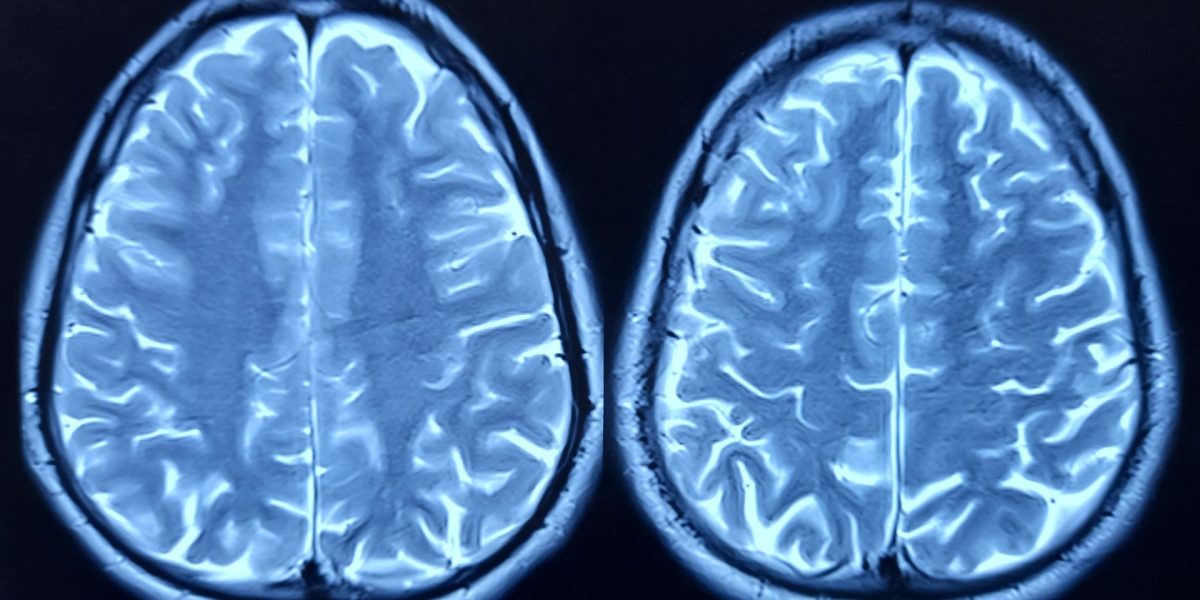 Oamenii de știință dezvăluie secretul îmbătrânirii creierului