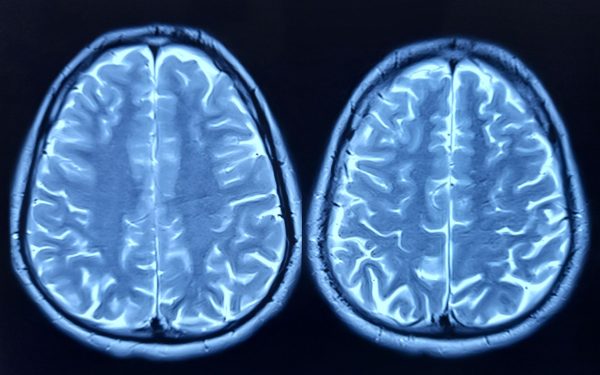 O proteină-cheie ar putea fi responsabilă pentru îmbătrânirea creierului, arată un studiu recent pe șoareci, oferind speranțe pentru noi tratamente