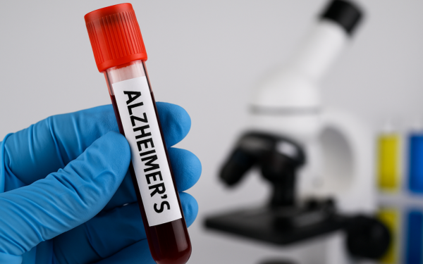 Un test de sânge simplu poate identifica riscul de demență cu decenii înainte ca simptomele să apară, oferind noi perspective în modul în care sunt prevenite și tratate afecțiunile cognitive