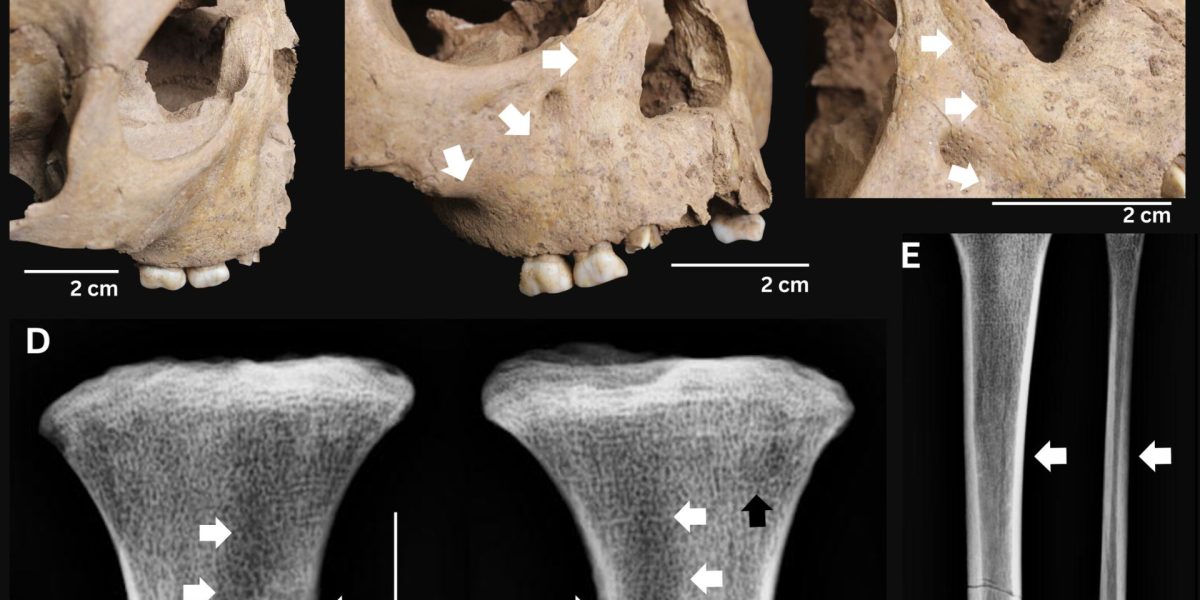 Dinții copiilor antici: Boala groaznică de acum 4.000 de ani iese la iveală