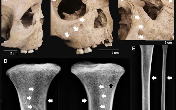 Arheologii au descoperit, în Vietnam, dovezi ale unei boli extrem de grave care afecta copiii antici, sugerând o reevaluare a teoriilor privind originea sifilisului