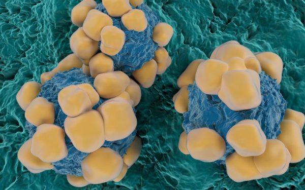 Oameni de știință, REVOLUȚIE: Senzori minusculi detectează cancerul rapid!