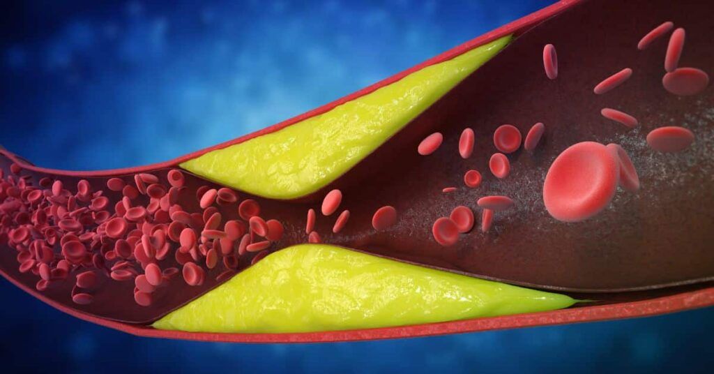 Șapte semne de ATHERO-SCELEROZĂ ignorate: Atenție la ce simțiți!