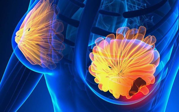 Semnele cancerului de sân: 5 simptome la care trebuie să fii atentă!