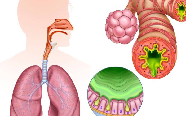Inflamația cronică, „dușmanul invizibil”: Cum ne afectează sănătatea