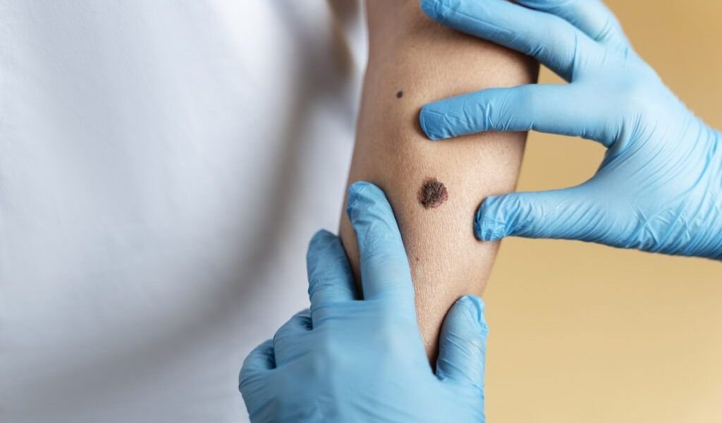 O femeie de 37 de ani, din Plymouth, Anglia, a murit din cauza unui melanom, cancer de piele, diagnosticat mult prea târziu, în ciuda semnalelor de alarmă pe care le-a ignorat
