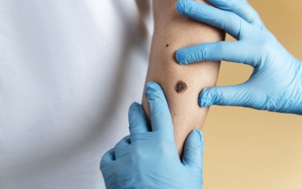 O femeie de 37 de ani, din Plymouth, Anglia, a murit din cauza unui melanom, cancer de piele, diagnosticat mult prea târziu, în ciuda semnalelor de alarmă pe care le-a ignorat
