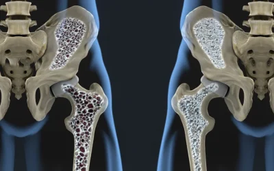 Nou tratament promite: oase mai puternice și luptă cu osteoporoza