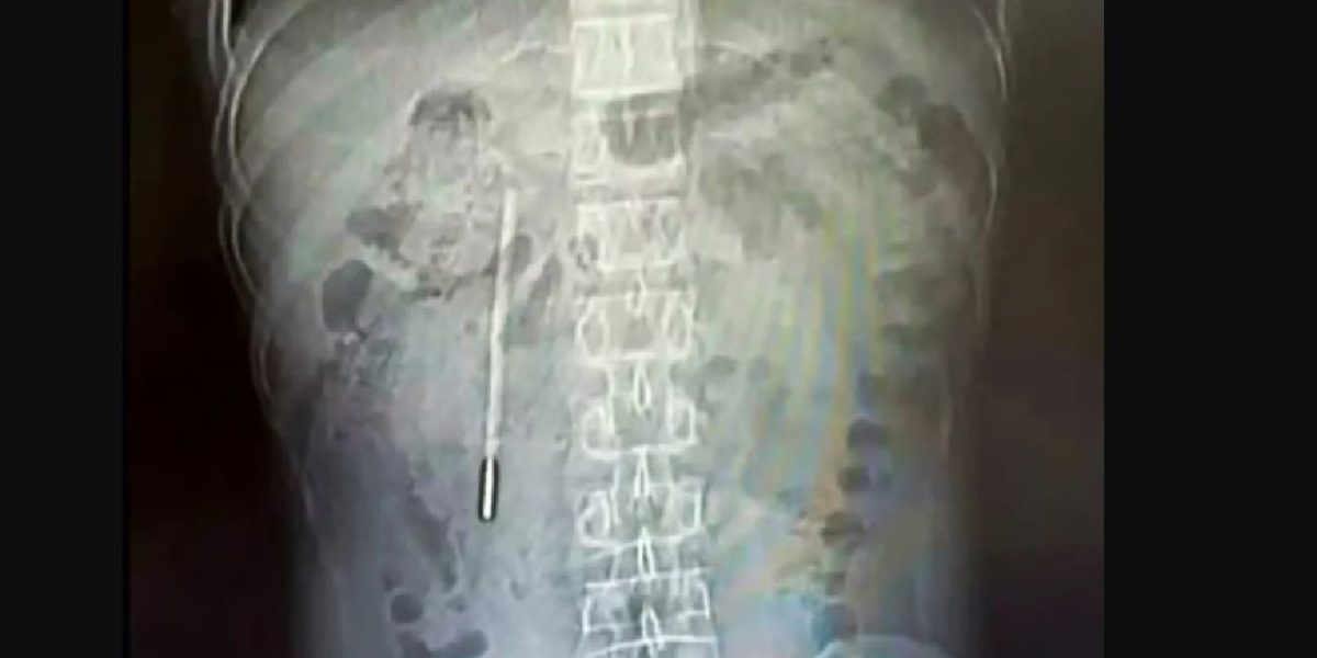 Medici, șocați: Ce au găsit în stomacul unui chinez după 20 de ani de dureri