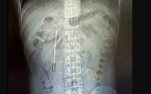 Medici, șocați: Ce au găsit în stomacul unui chinez după 20 de ani de dureri