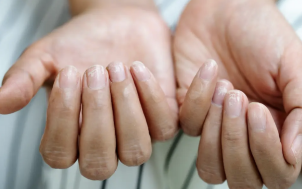 Unghiile Terry: Semnalul ascuns al bolilor grave. Ce indică afecțiunea