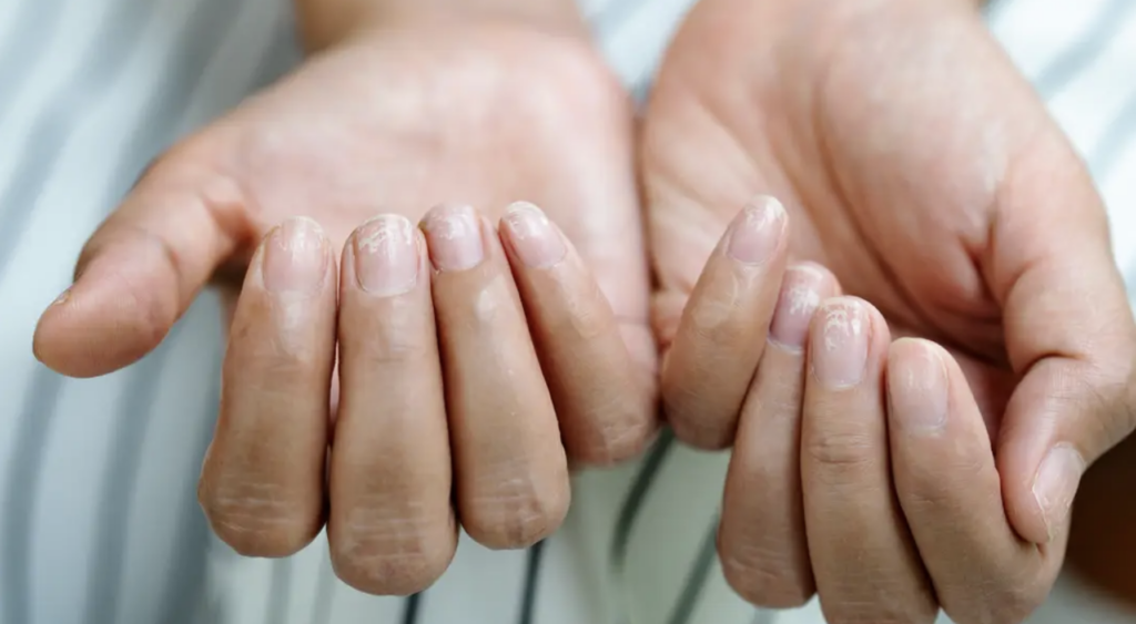 Unghiile Terry: Semnalul ascuns al bolilor grave. Ce indică afecțiunea