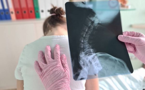 Copiii stau cocoșați: Osteopat explică cauza reală, nu doar telefonul